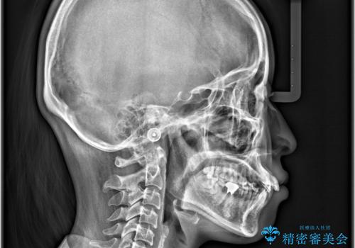 歯のデコボコ|口ボコ|八重歯が気になる!|ワイヤー矯正の治療前