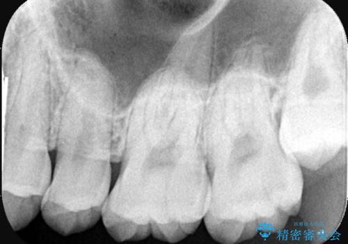 【セラミックインレー】歯科検診で虫歯が見つかったの治療前