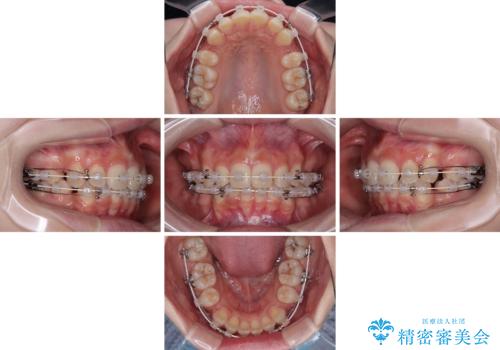出っ歯を治したい ワイヤー装置での抜歯矯正の治療中
