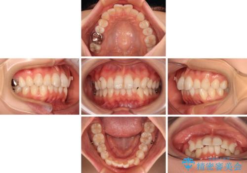マウスピースが面倒くさい インビザラインでできるところまで頑張った矯正治療の治療中