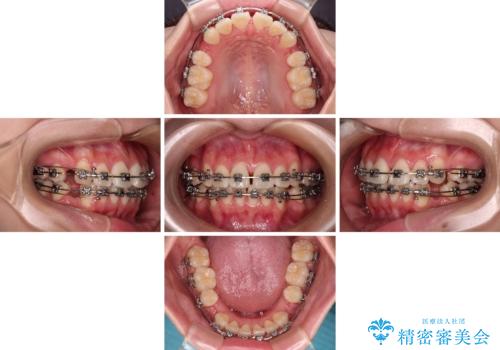【モニター】とがった口元を抜歯して改善 ワイヤー装置の矯正治療の治療中