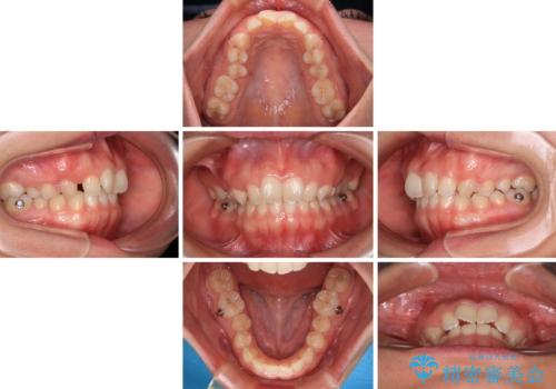 補助装置を併用して確実に インビザラインで奥歯の咬み合わせをしっかりと改善の治療中
