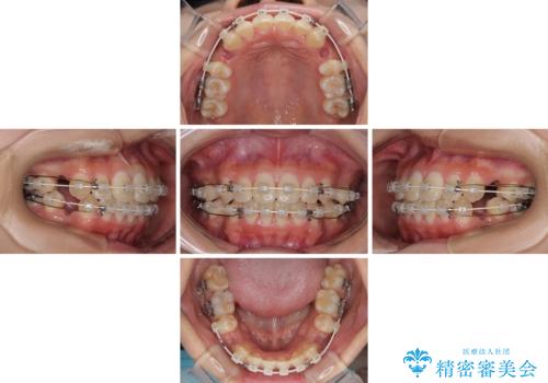 急速拡大装置 狭い骨幅を拡大した上で、口元の突出感を改善する抜歯矯正治療の治療中