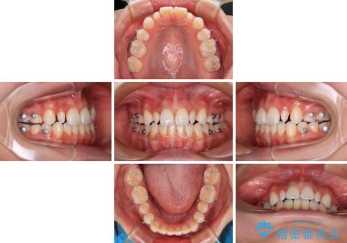 飛び出した前歯 インビザラインを用いた抜歯矯正治療の治療中