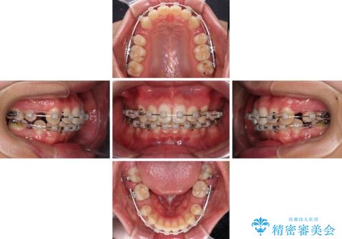 上の前歯が下唇に引っかかる 口元を引っ込めすぎない抜歯矯正治療の治療中