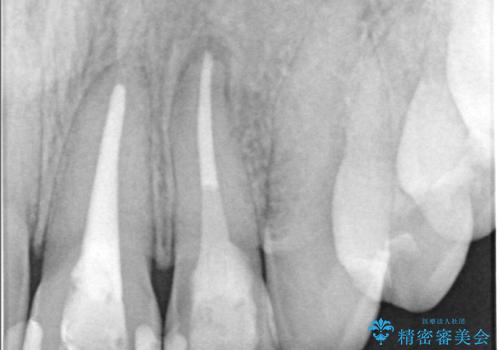 前歯が痛い!|歯の色が気になる!|精密根管治療後、オールセラミッククラウンで審美修復の治療前