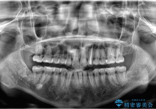 歯のデコボコを治したい! |インビザラインでわずか6ヵ月で矯正完了!の治療後