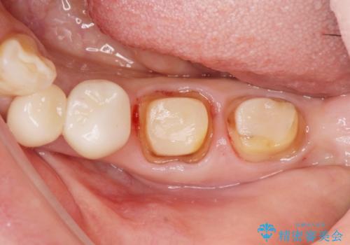 銀歯の除去 長期的な未来を見据えた虫歯治療の治療中