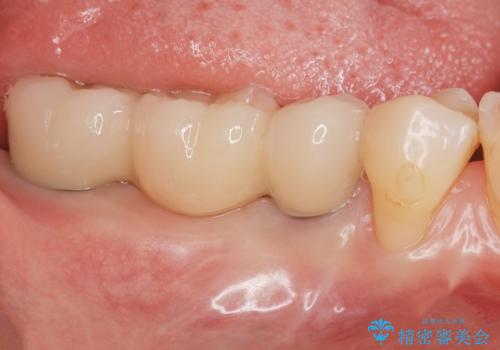 失った奥歯をインプラントで機能回復の症例 治療後