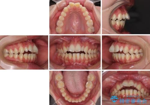飛び出した前歯 インビザラインを用いた抜歯矯正治療の治療前