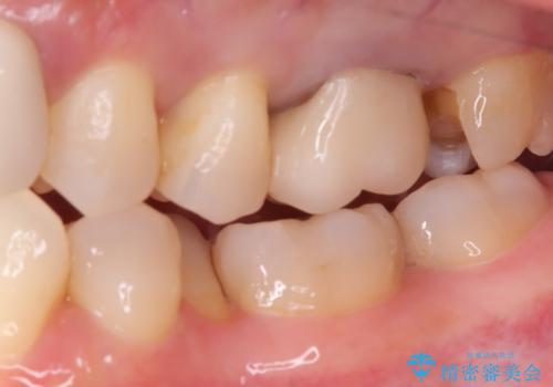 【セラミックインレー】口の中から金属を無くしたいの治療中