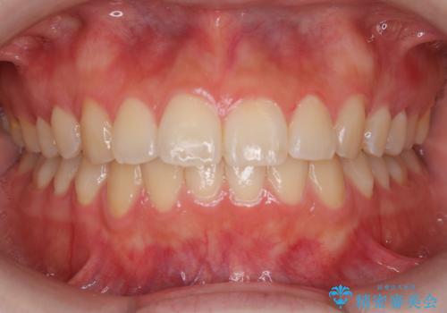 1回でこんなに白く⁉の治療前