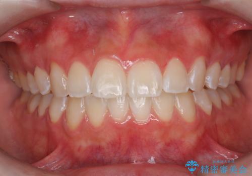 1回でこんなに白く⁉