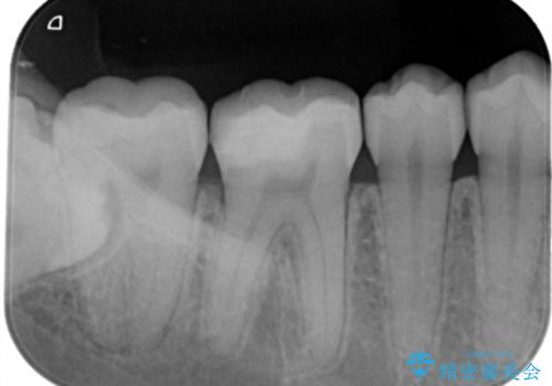 奥歯の虫歯を直したい セラミックインレーの治療後