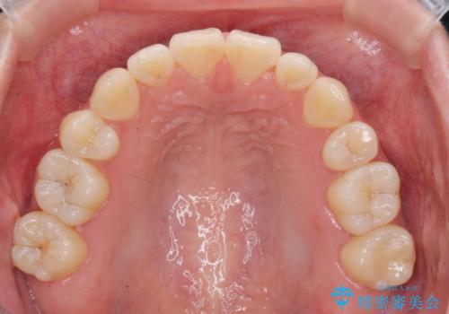 マウスピースで行う出っ歯の改善 後方移動の治療後