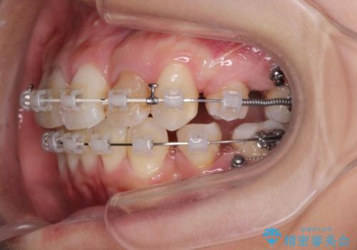 がたつきと出っ歯 ワイヤー矯正での歯並び改善の治療中