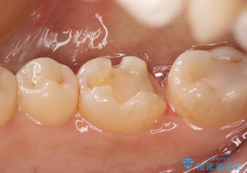 奥歯の虫歯を直したい セラミックインレーの治療中