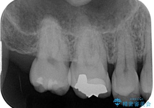 舌で触ると段差が気になる ゴールドインレー修復の治療後