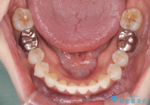 抜歯をせず前歯の角度を改善するマウスピース矯正治療の治療中