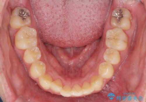 正中過剰埋伏歯で生じた前歯の審美障害 矯正治療での改善の治療後