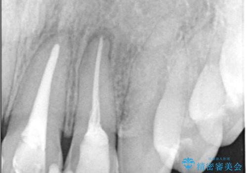 前歯が痛い!|歯の色が気になる!|精密根管治療後、オールセラミッククラウンで審美修復の治療中