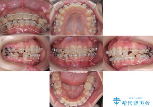 歯のデコボコ|口ボコ|八重歯が気になる!|ワイヤー矯正の治療中