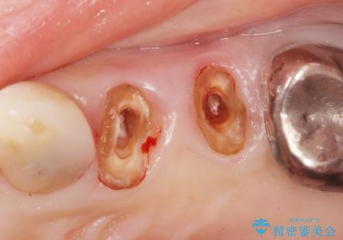 銀歯の除去 長期的な未来を見据えた虫歯治療の治療前