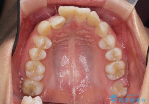 がたつきと出っ歯 ワイヤー矯正での歯並び改善の治療前