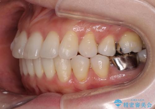 抜歯をせず前歯の角度を改善するマウスピース矯正治療の治療中