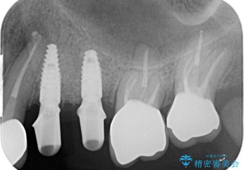 銀歯の除去 長期的な未来を見据えた虫歯治療の治療中