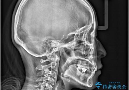 歯のデコボコ|口ボコ|八重歯が気になる!|ワイヤー矯正の治療後