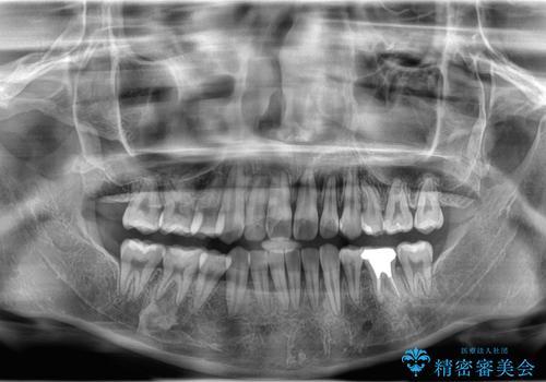 歯のデコボコ|口ボコ|八重歯が気になる!|ワイヤー矯正の治療後