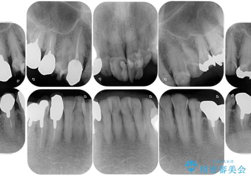 歯がボロボロで咬合崩壊 矯正・インプラント・セラミックで実現する、酸蝕症の総合治療の治療前
