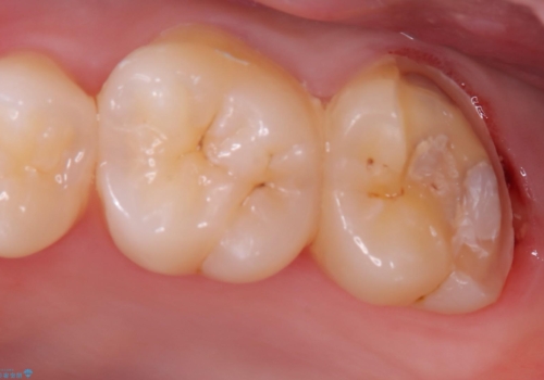 【セラミックインレー】歯科検診で虫歯が見つかったの治療中