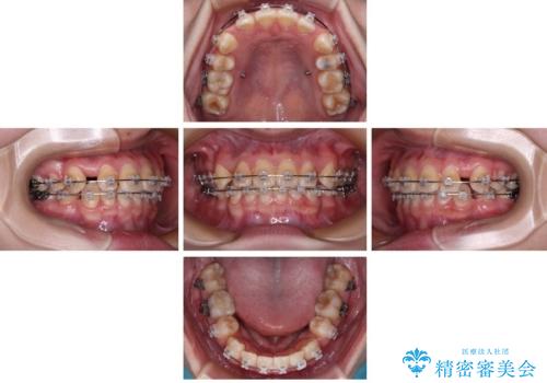 転勤でも安心して治療継続 抜歯スペース閉鎖と深い噛み合わせ改善のワイヤー矯正の治療前