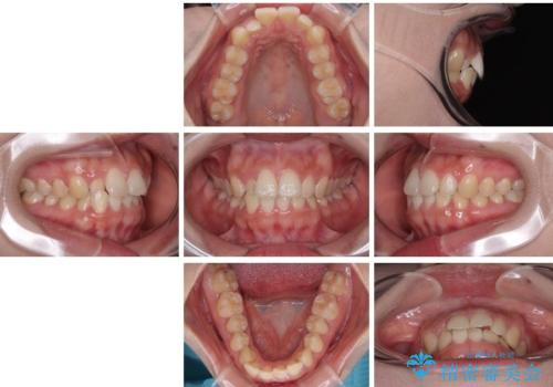 目立ちにくい表側装置で1年完了!狭いアーチを側方拡大し前歯のデコボコを整えた症例の治療前