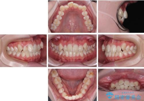 【モニター】前歯のデコボコをスッキリ解消!目立ちにくいワイヤー矯正でスピーディに治療完了の治療前