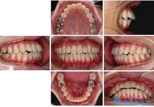 口元の突出感を改善!目立ちにくいワイヤー矯正で自信を持てる自然な横顔にの治療前