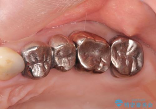 銀歯の除去 長期的な未来を見据えた虫歯治療の治療前