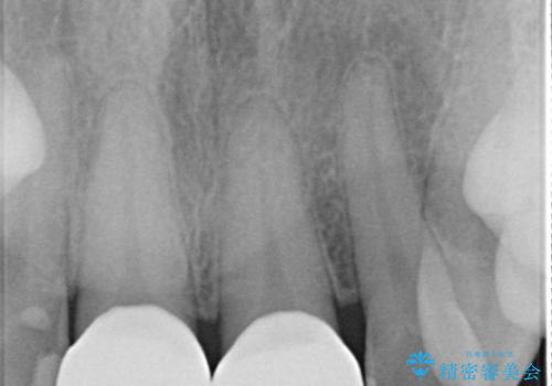 前歯の色が気になる　オールセラミッククラウンで綺麗で健康な歯にの治療後
