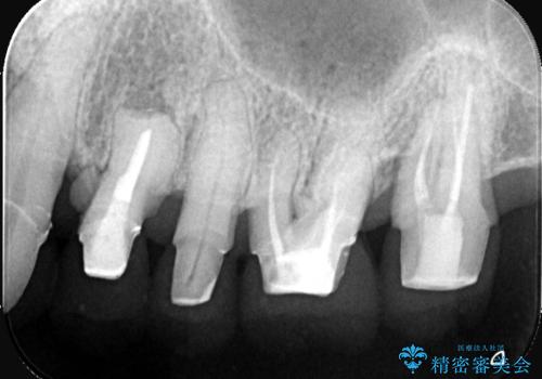 難症例の奥歯も3ヶ月で機能回復!抜歯即時インプラントでスピード解決の症例 治療前