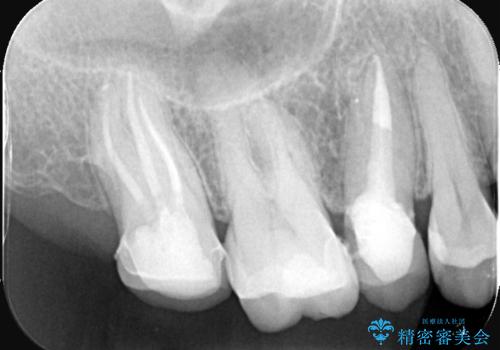 奥歯の根の病変も精密治療で解決の症例 治療後