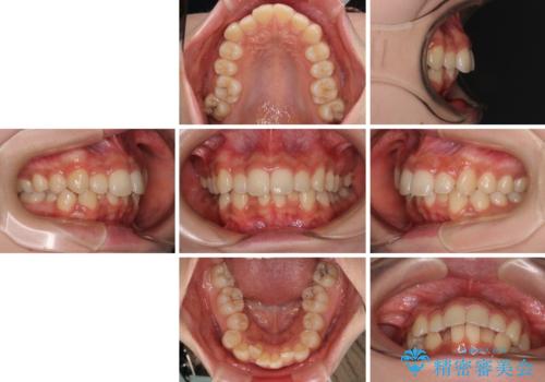 出っ歯を治したい ワイヤー装置での抜歯矯正の治療前