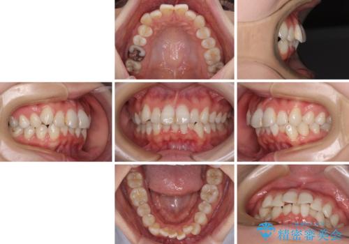 マウスピースが面倒くさい インビザラインでできるところまで頑張った矯正治療の治療前
