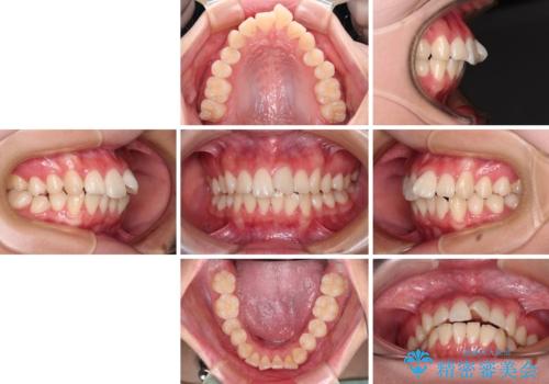 【モニター】とがった口元を抜歯して改善 ワイヤー装置の矯正治療の治療前