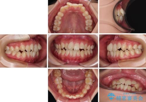 急速拡大装置 狭い骨幅を拡大した上で、口元の突出感を改善する抜歯矯正治療の治療前