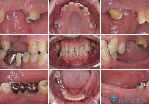 欠損の多い奥歯 インプラントによる補綴治療の治療前