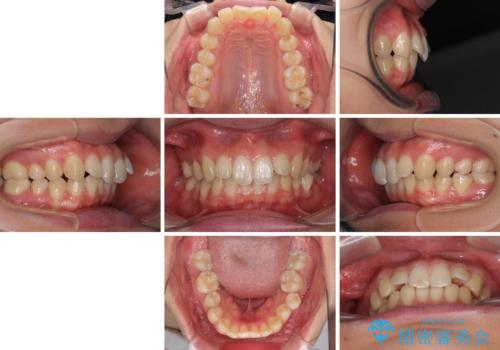上の前歯が下唇に引っかかる 口元を引っ込めすぎない抜歯矯正治療の治療前