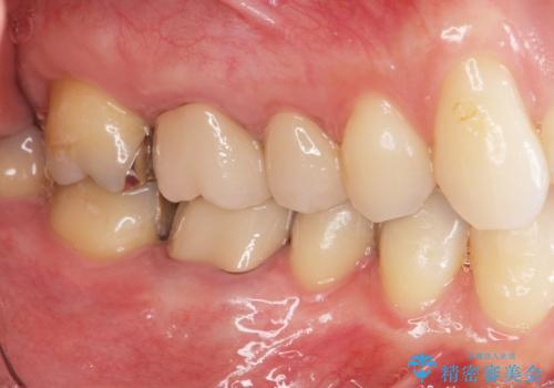 矯正と虫歯のセラミック治療 総合歯科治療の実践の治療後