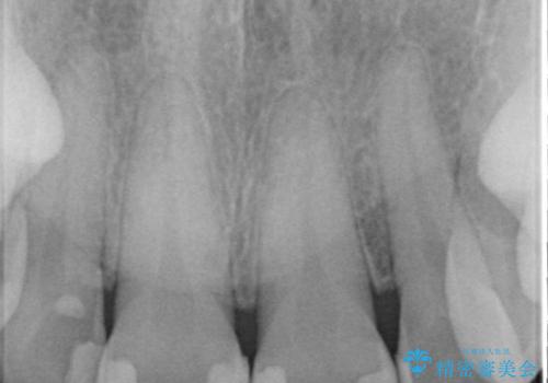 前歯の色が気になる　オールセラミッククラウンで綺麗で健康な歯にの治療前